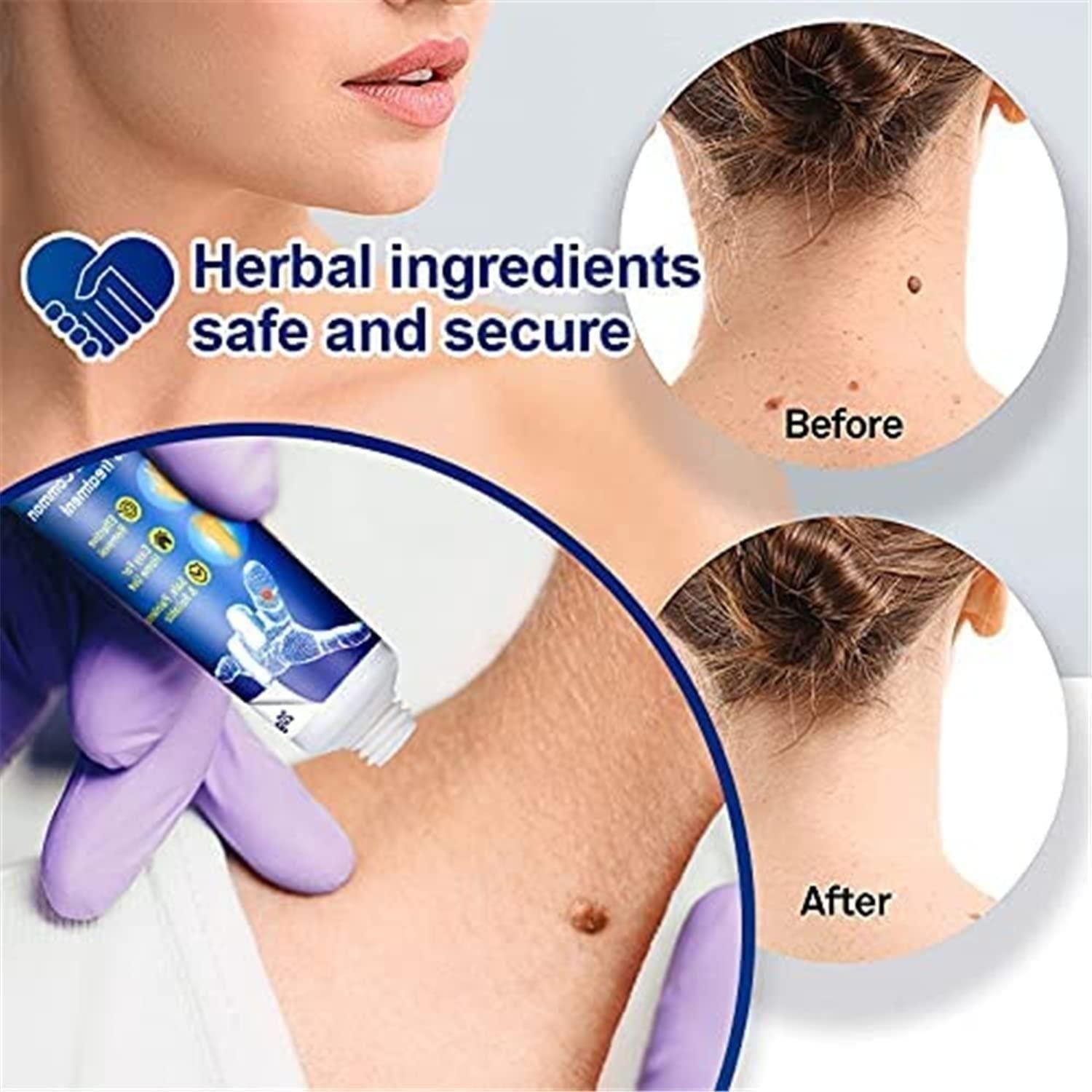 Warts Remover Cream | No Warts from Today | 75% OFF Today