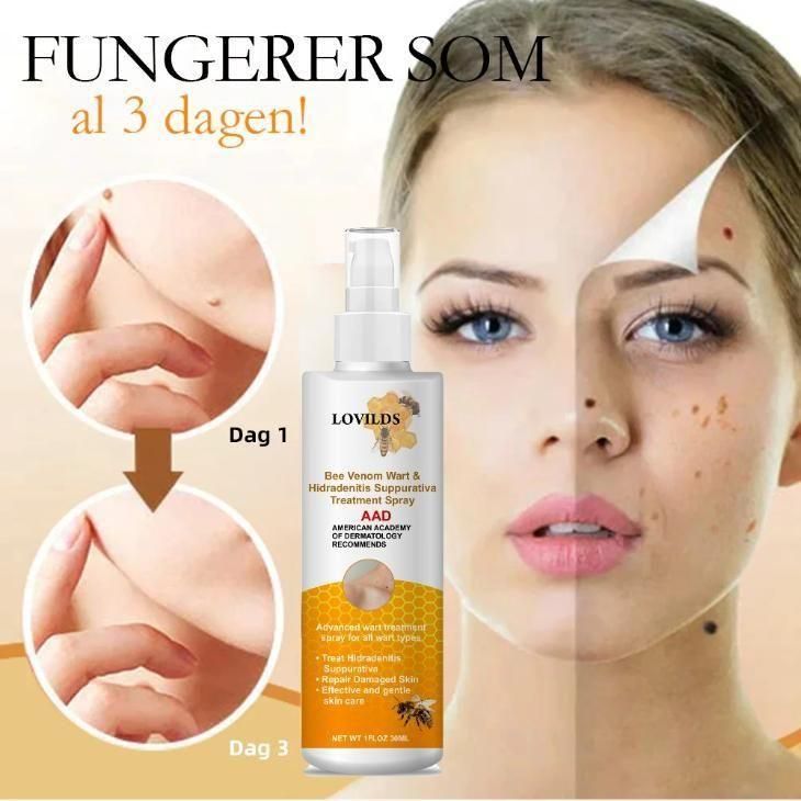 Bee Venom Wart Remover Spray | 30ml | 75% OFF Today