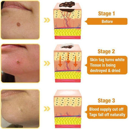 Bee Venom Wart Remover Spray | 30ml | 75% OFF Today