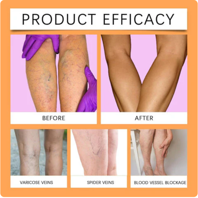 Turmeric Varicose Veins Relief Spray (BUY 1 GET 1 FREE)
