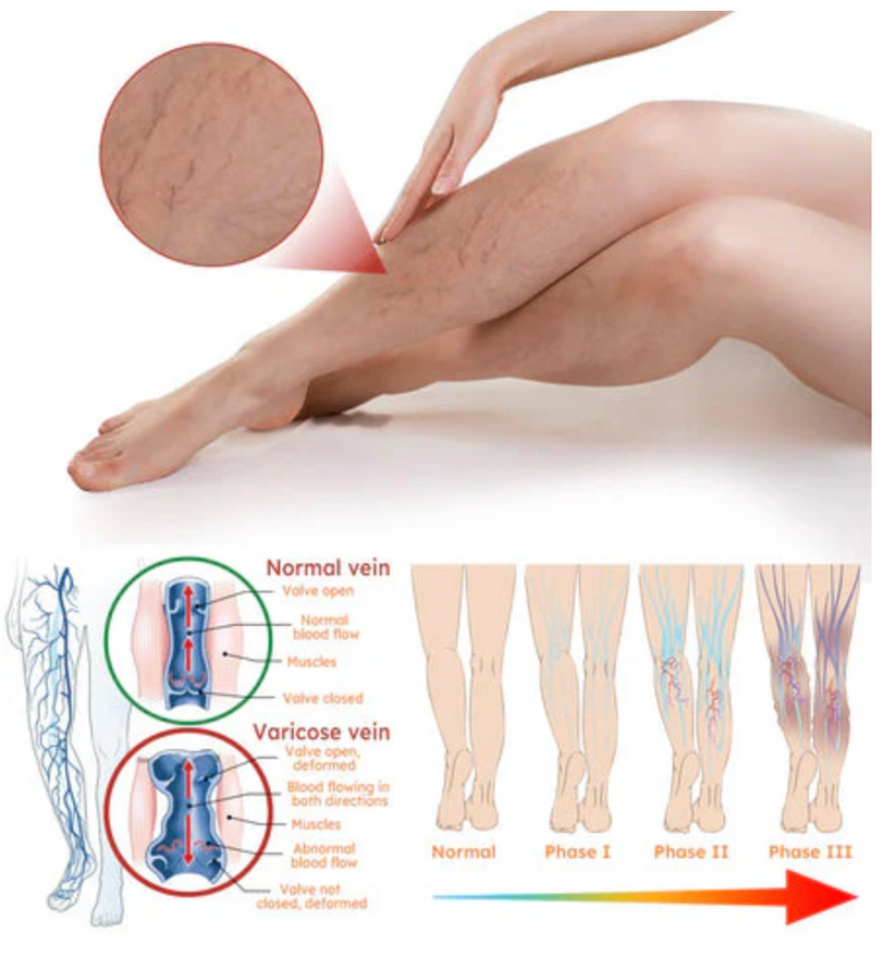 Turmeric Varicose Veins Relief Spray (BUY 1 GET 1 FREE)