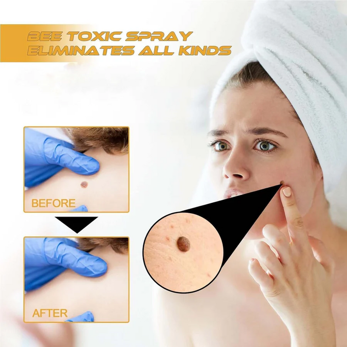 Bee Venom Wart Remover Spray | 30ml | 75% OFF Today